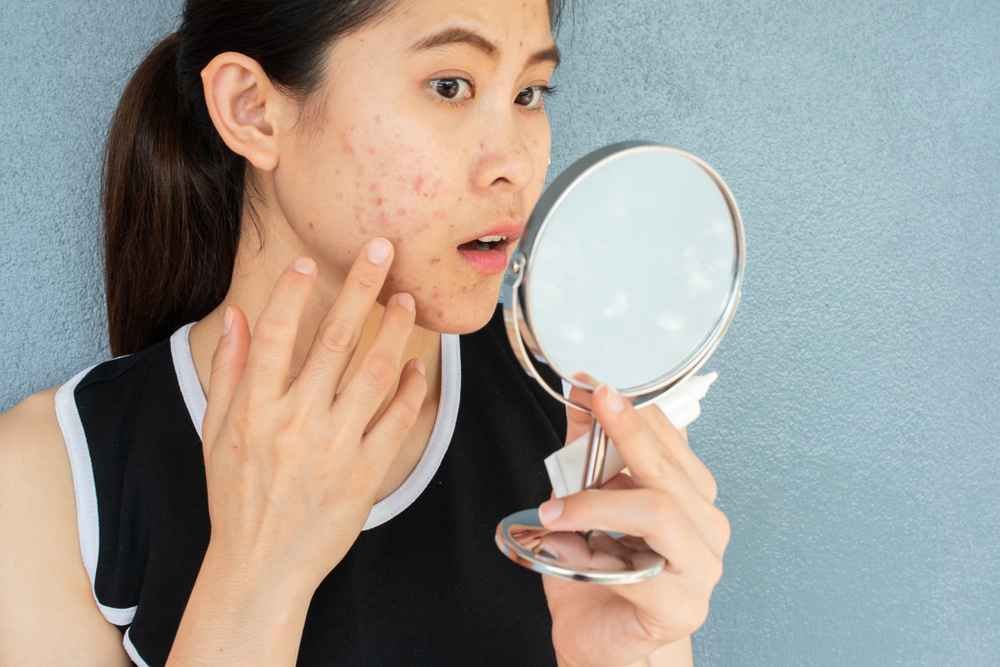 Cek 7 Cara Menghilangkan Bekas Jerawat Berikut Ini!