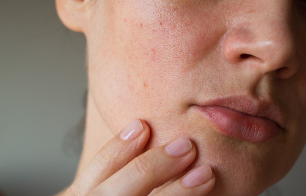 Kandungan dan Rekomendasi Skincare yang Cocok untuk Kulit Kering