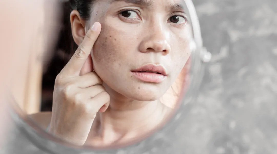 wanita dengan flek hitam mencari cara menghilangkan bintik hitam di wajah.