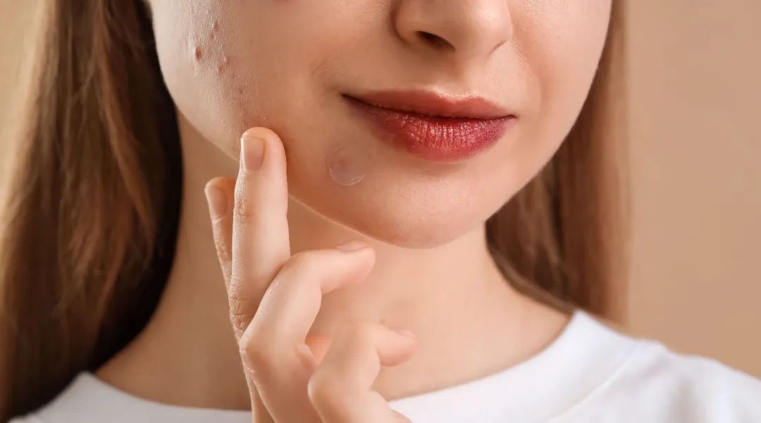 Rekomendasi Skincare La Roche-Posay untuk Jerawat