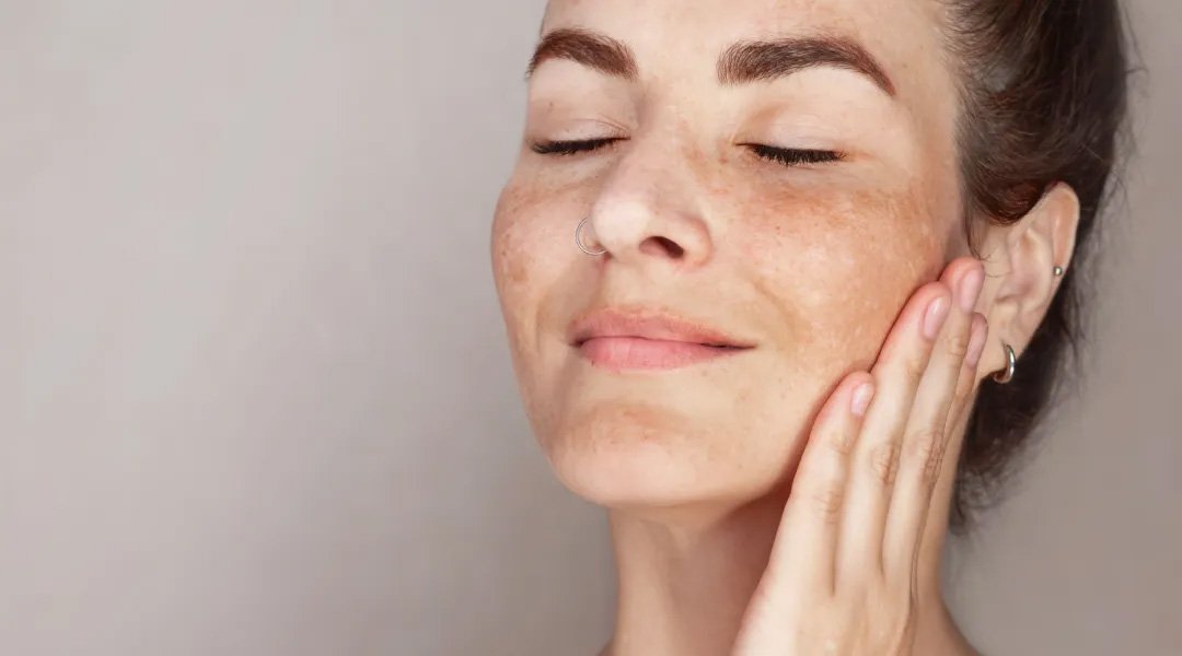 wanita dengan flek hitam mencari cara menghilangkan bintik hitam di wajah.