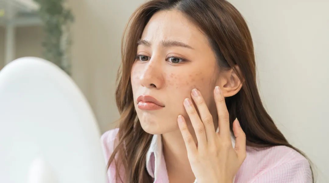 wanita menggunakan skincare untuk menghilangkan flek hitam