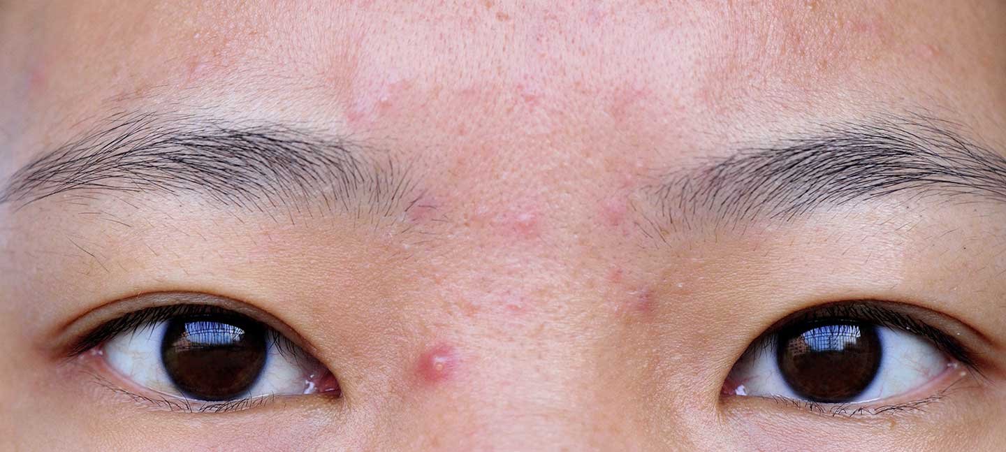 laroche posay ConcernPage Acne symptoms