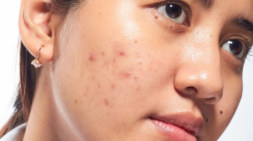 wanita menggunakan sunscreen untuk flek hitam