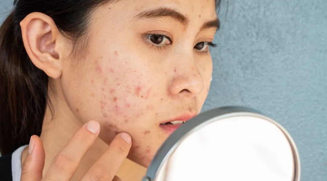 wanita menggunakan sunscreen untuk flek hitam