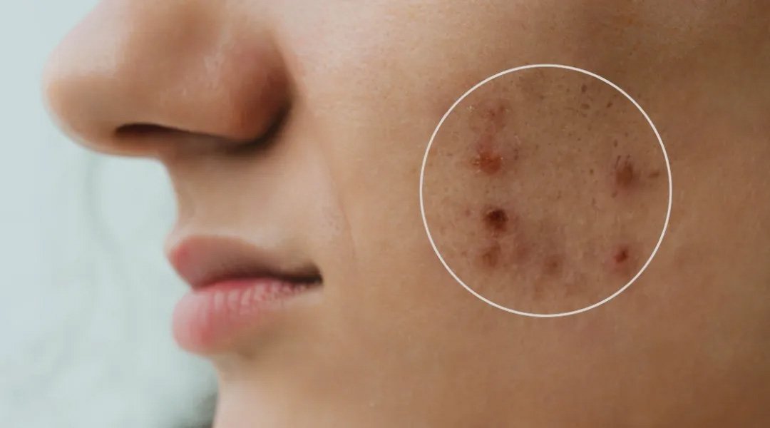 7 Kandungan Skincare untuk Menghilangkan Bekas Jerawat